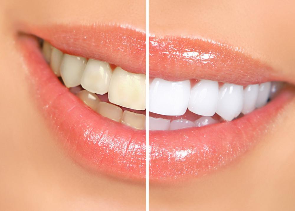 Why Professional Teeth Whitening is Superior to Over-the-Counter Products