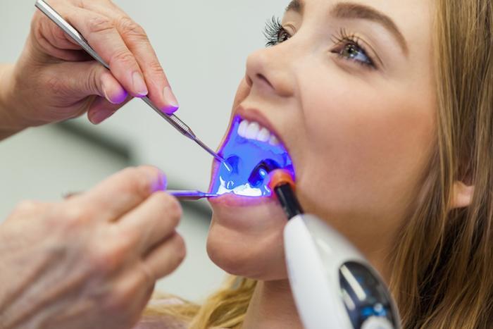 How to Extend the Results of Teeth Whitening