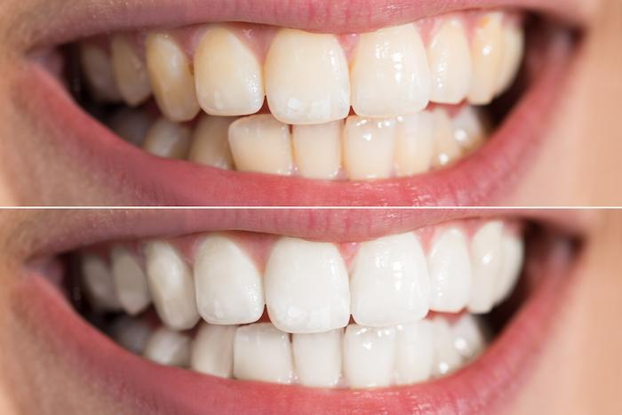 Help! My Teeth Are Yellow