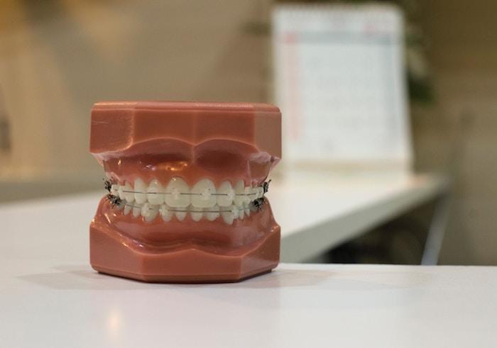 No More Metal Mouth: Straighten Your Teeth With Clear Braces