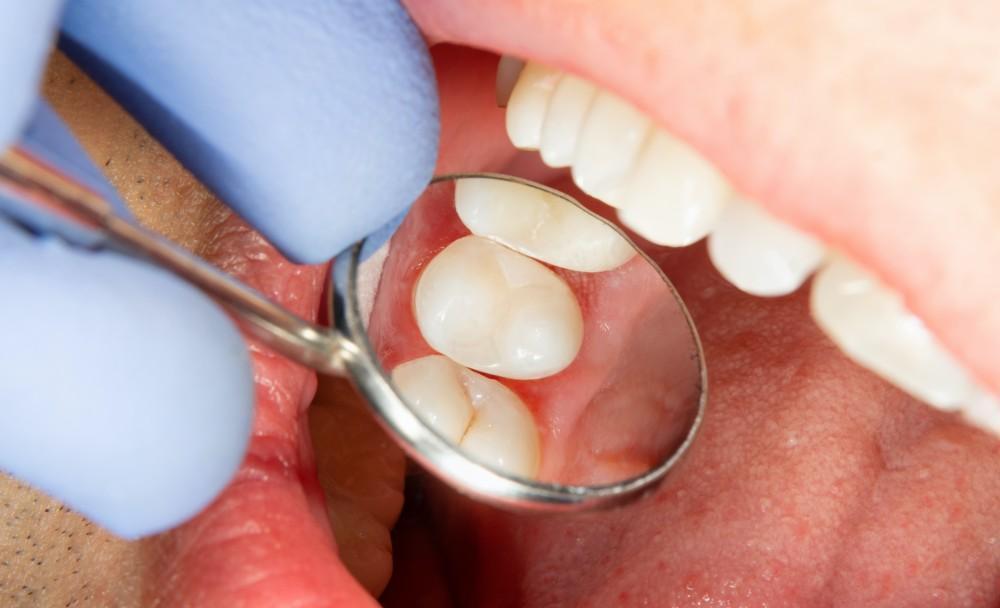 5 Smile Flaws Easily Corrected With Veneers