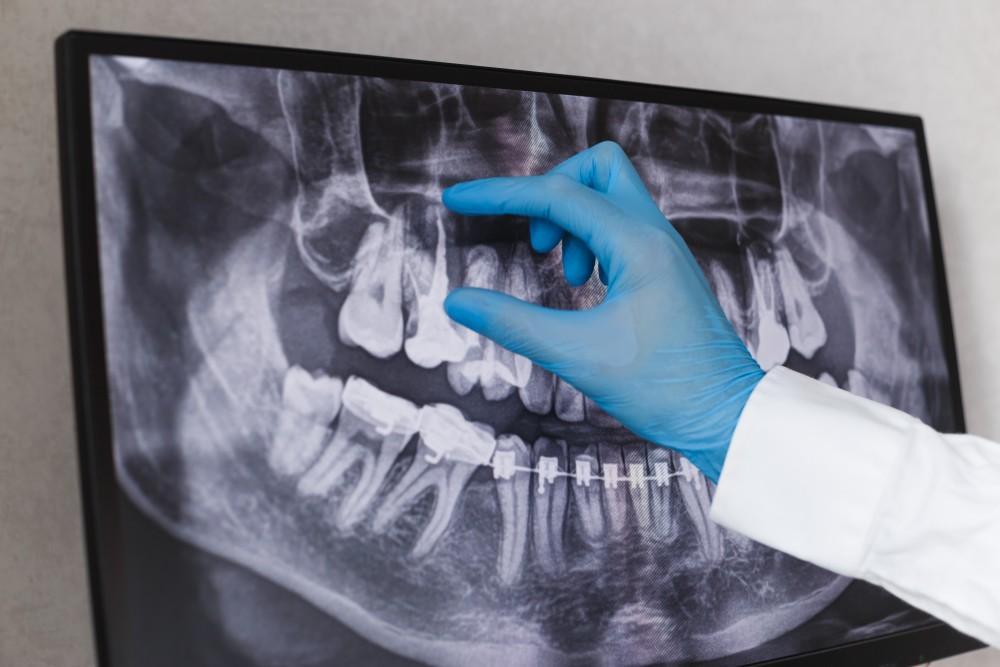Here’s Why a Tooth-Saving Root Canal Is Nothing to Fear