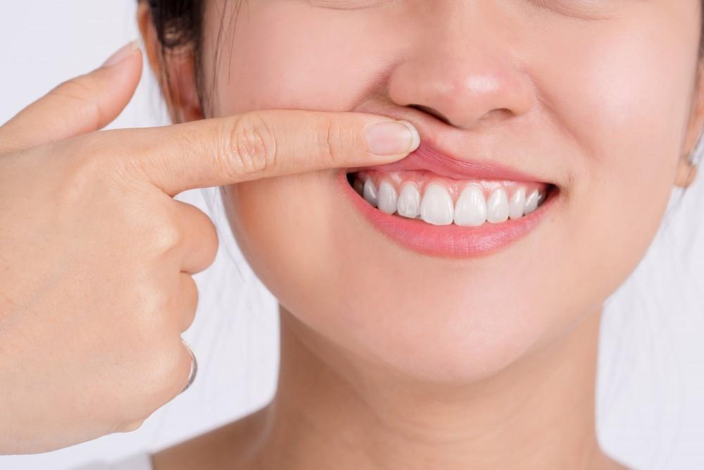 Gingivitis 101: Act Fast to Reverse Early-Stage Gum Disease