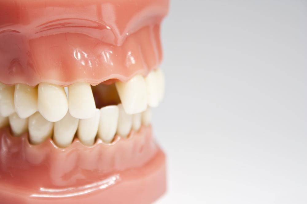 All About Adult Tooth Loss: Causes, Prevention, and Treatment Options