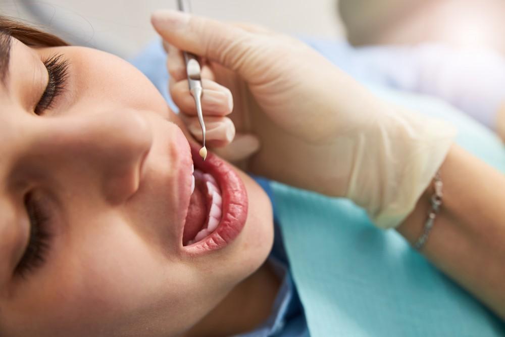 Why Do Some People Prefer Mercury-Free Fillings?